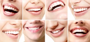diferencas-sorriso-lente-dental-facetas