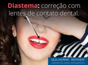 lente-de-contato-dental-corrigir-buraco-entre-dentes-diastema-ipanema
