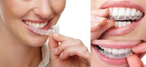aparelho-ortodontico-transparente-ipanema-invisalign-alinhador