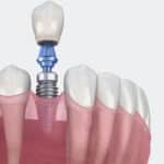clinica-dentaria-implantes-rj-ipanema