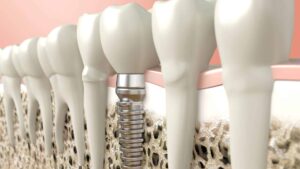 parafuso-ceramica-implante-dentario-em-ipanema