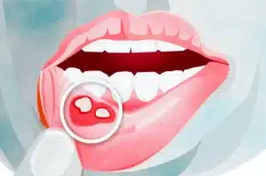 como prevenir afta como prevenir afta