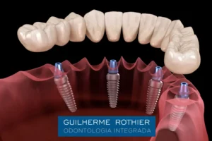 dentista-implante-boca-inteira-ipanema